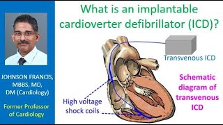 What is an implantable cardioverter defibrillator ICD [upl. by Mei]