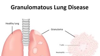 Granulomatous diseases of Lung Introduction [upl. by Thordis]