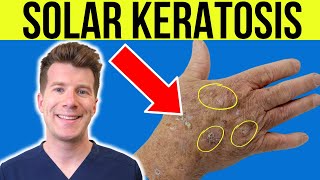 Doctor explains Actinic Solar Keratosis  Sun damaged skin  causes symptoms and treatment [upl. by Maddeu]