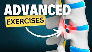 Advanced Exercises to Relieve Sciatica or Sciatic Pain Herniated Disc [upl. by Shreeves]