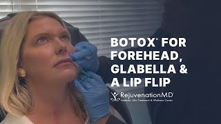 Lip Flip With Botox [upl. by Aerdnat47]