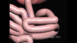 Intussusception of the Bowel video  Animation by Cal Shipley MD [upl. by Durarte]