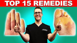 Raynauds Syndrome Top 15 Remedies Symptoms amp Best Treatment [upl. by Viola]