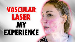 My FIRST time Trying the VASCULAR LASER Here’s What I Learned [upl. by Cioban537]