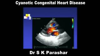 Cyanotic Congenital Heart Disease Dr S K Parashar [upl. by Noirad]