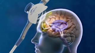 How Does Transcranial Magnetic Stimulation work [upl. by Trab935]