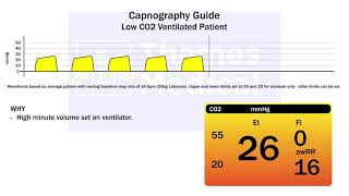 Capnography Waveforms Low CO2 Ventilated Patient [upl. by Sosthina493]