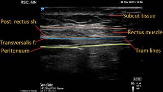 Continuous Rectus sheath block for post laparotomy analgesia [upl. by Ardelle]