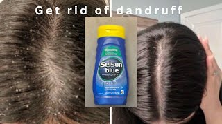 HOW TO GET RID OF DANDRUFF  Selsun Blue Anti Dandruff Shampoo  Honest Review [upl. by Polloch]