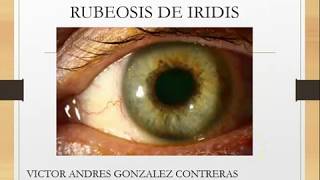 Rubeosis de iridis por Victor Gonzalez [upl. by Eiduam]