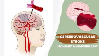 Cerebrovascular accident or stroke  Ischemic and hemorrhagic [upl. by Jamila]