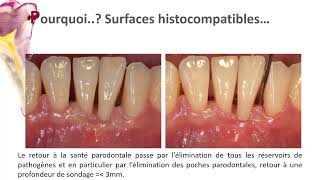 le Détartrage surfaçage radiculaire Un acte de bonne pratique [upl. by Assirrem912]