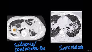 tkrDDS 14 SILICOSISCOAL WORKER PNEUMOCONIOSIS VS SARCOIDOSIS ON HRCT [upl. by Savior]