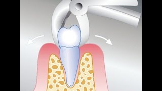 für Zahnärzte Zahn ziehen [upl. by Roselani]