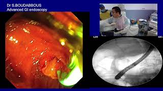 ERCP for acute cholangitis [upl. by Anagrom]