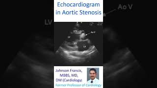 Echocardiogram in Aortic Stenosis [upl. by Aurora991]