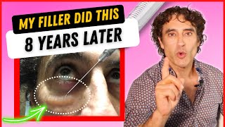 MY UNDER EYE FILLER REACTION 8 YEARS LATER And HOW IM FIXING IT [upl. by Esinej]