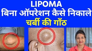 चर्बी की गाँठ  LIPOMA  को बिना ऑपरेशन कैसे निकाले । LIPOMA homeopathic treatment [upl. by Anemolif]