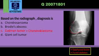 Differentiating epiphyseal lesions Chondroblastoma vs Giant cell tumor [upl. by Natloz]