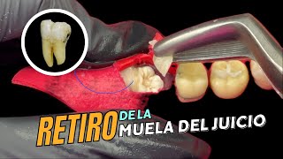 EXTRACCION de muela del juicio RETENIDA  Oralay Dental [upl. by Merline]