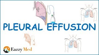 Pleural Effusion Causes ClassificationSymptoms and Treatment [upl. by Flemings]