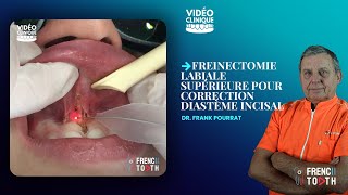 Freinectomie labiale supérieure pour correction diastème incisal  Dr Pourrat [upl. by Lemmy]