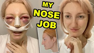 MY NOSE JOB  PART 1  RHINOPLASTY amp SEPTOPLASTY SURGERY amp RECOVERY 2020 [upl. by Gareri447]