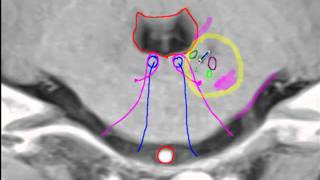 Anterior inferior cerebellar artery [upl. by Cheatham]