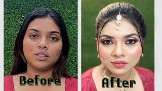 HOW TO COVER ACNE with MAKEUP  Easy Makeup Hack ￼l Best makeup on acne skin tutorial [upl. by Anicart]