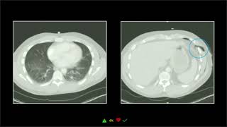 Thoracoabdominal Trauma Part 3  Free Radiology CME [upl. by Salohcim]