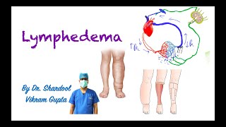 Lymphedema for MBBS MS Surgery medical students [upl. by Vashtia770]