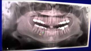 CBCT Scan using Veraviewepocs 3De [upl. by Mufinella]