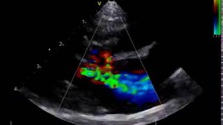 Apex Cardiology  Systolic anterior motion of the mitral valve SAM in a cat [upl. by Tereb]