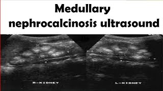 Medullary nephrocalcinosis Ultrasound [upl. by Aicilaanna]