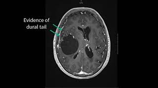 Grade 1 Meningioma [upl. by Nywde]