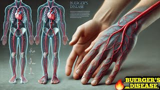 Buergers Disease Thromboangiitis Obliterans Easy Explanation [upl. by Cheng]