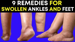 9 Effective Remedies for Swollen Ankles and Feet That Really Work [upl. by Foley]