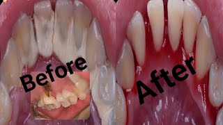 Tartar removed from teeth secret of teeth cleaning [upl. by Naeroled]