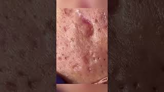 Satisfying Blackhead Removal Clear Skin Transformation Part 10 [upl. by Jaenicke]