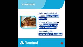 Case Report  Flaminal® Forte in the recovery from Severe Burns [upl. by Nue912]