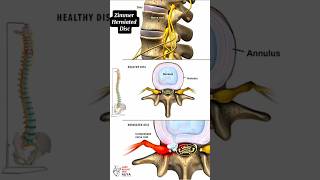 Zimmer Herniated Disc medical animation 3d short [upl. by Caleb]