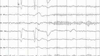 EEG Tutorial [upl. by Penelope]