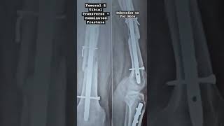 Femoral FractureTibial Fracture  Transverse Fracture Comminuted Fracture physiotherapy fracture [upl. by Zehe]