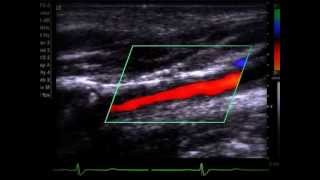 Doppler de carótidas e vertebrais [upl. by Elay]