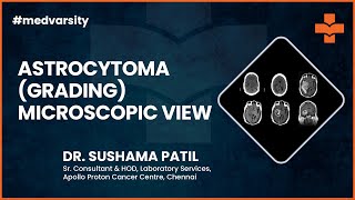 Understanding Astrocytoma Grading Microscopic View  Medical Case Discussion [upl. by Amble471]