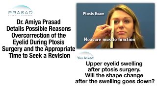 How Swelling after Ptosis Surgery Can Raise the Eyelid and the Right Time for Enhancement [upl. by Atilegna341]