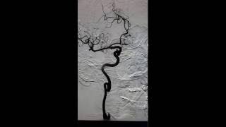 Right internal carotid artery angiogram [upl. by Ycniuqed]