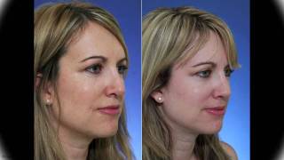 Revision Rhinoplasty for Pollybeak Deformity and Hanging Columella [upl. by Corena132]