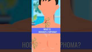 What is HODGKINS LYMPHOMA [upl. by Hgeilyak]