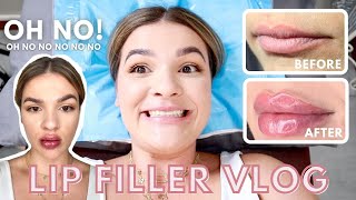 GETTING MY LIPS DONE 👄  MY LIP FILLER EXPERIENCE BEFORE AND AFTER 💉 [upl. by Nathalia]